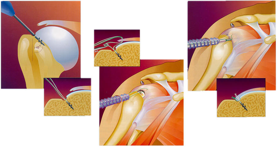 Shoulder Arthroscopy: Rotator Cuff Repair