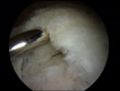 Rotator Cuff Tear Seen with Arthroscope