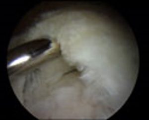 Rotator Cuff Tear Seen with Arthroscope