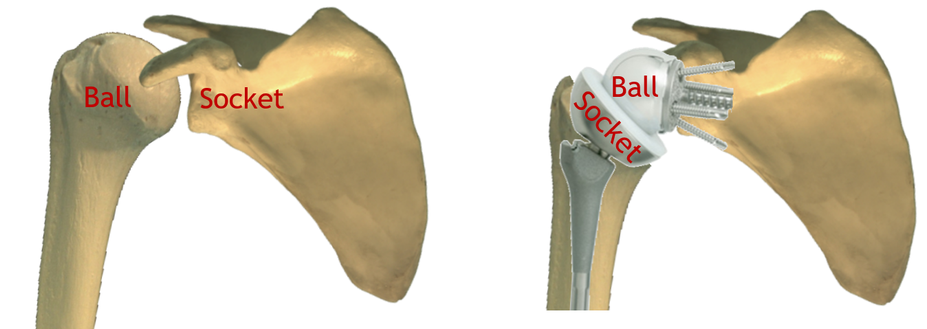 Reverse Shoulder Replacement at 10 Years: Indications and Outcomes ...