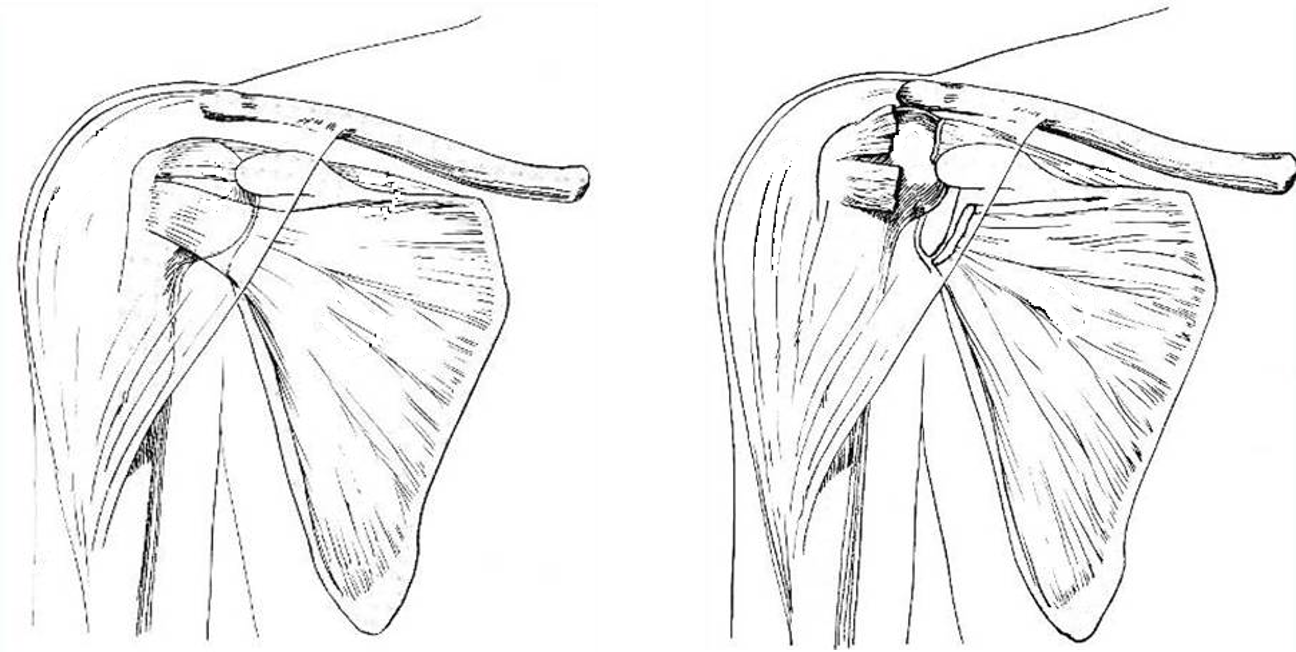 How to Treat Massive Rotator Cuff Tears - Repair or Replace? : Restoration  Orthopaedics